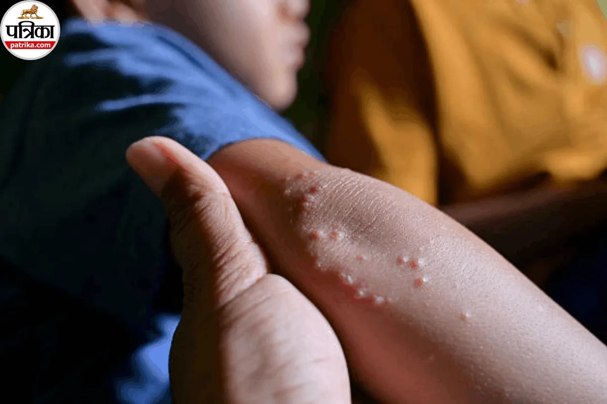 Molluscum Contagiosum, Molluscum Contagiosum Treatment