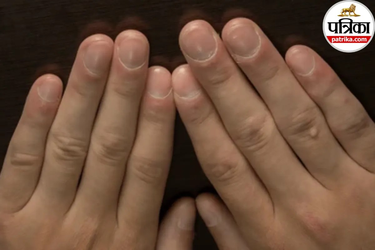 Nail clubbing causes,Curved fingernails symptoms,Nail clubbing lung cancer,