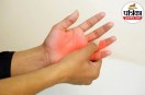 Paresthesia causes and symptoms,Pins and needles in hands and feet,Numbness and tingling in limbs,
