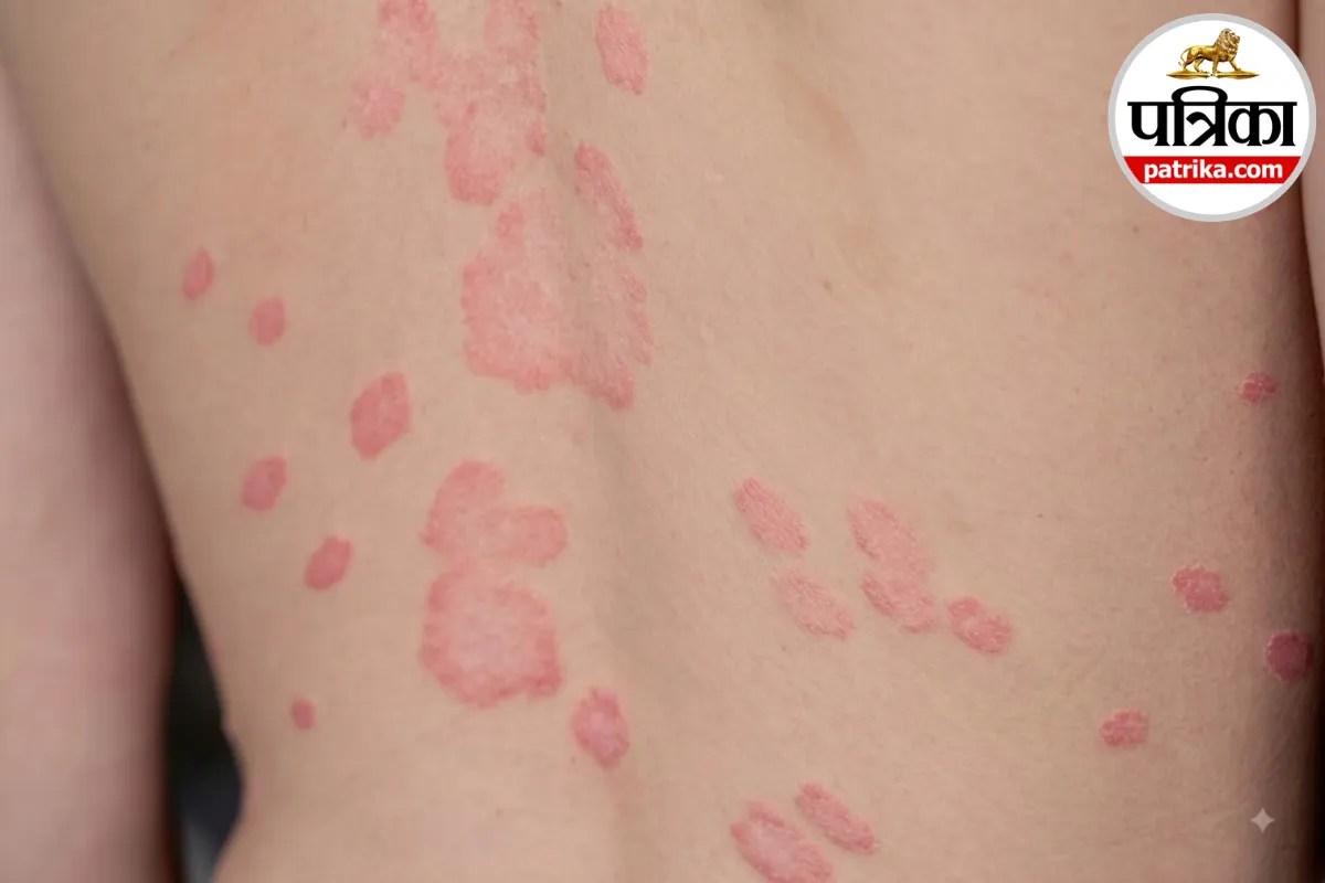 Pityriasis rosea rash causes and symptoms,Red pink spots on skin herald patch,Pityriasis rosea treatment at home,