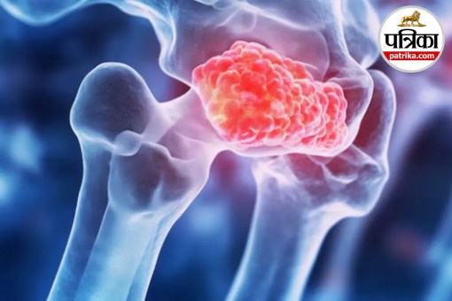 Bone cancer symptoms,Sarcoma warning signs,Unexplained bone pain,