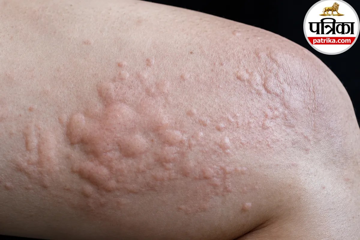 scabies symptoms and treatment,night itching and red bumps skin infection,how does scabies spread in family,