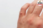 skin tags causes and treatment,how to remove skin tags safely,acrochordons medical reasons,