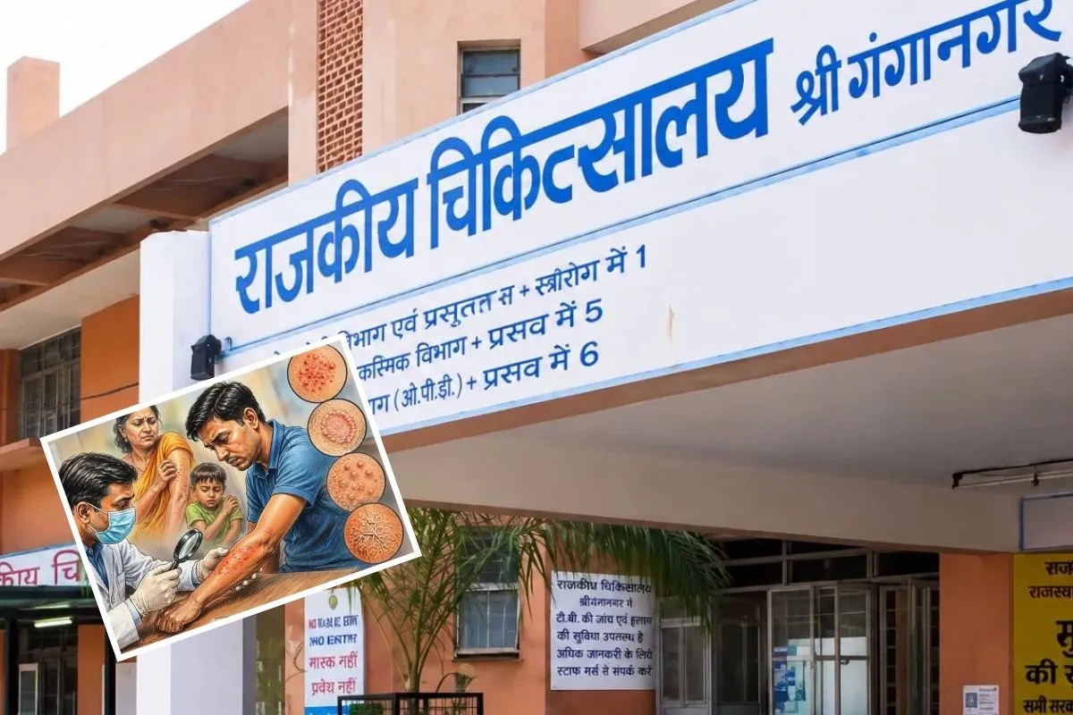 Sri Ganganagar Scabies fungal infection wreak havoc 150 people reach OPD Know