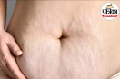post pregnancy stretch marks,stretch marks after pregnancy,how to lighten stretch marks,