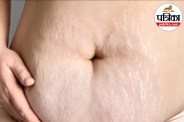 post pregnancy stretch marks,stretch marks after pregnancy,how to lighten stretch marks,
