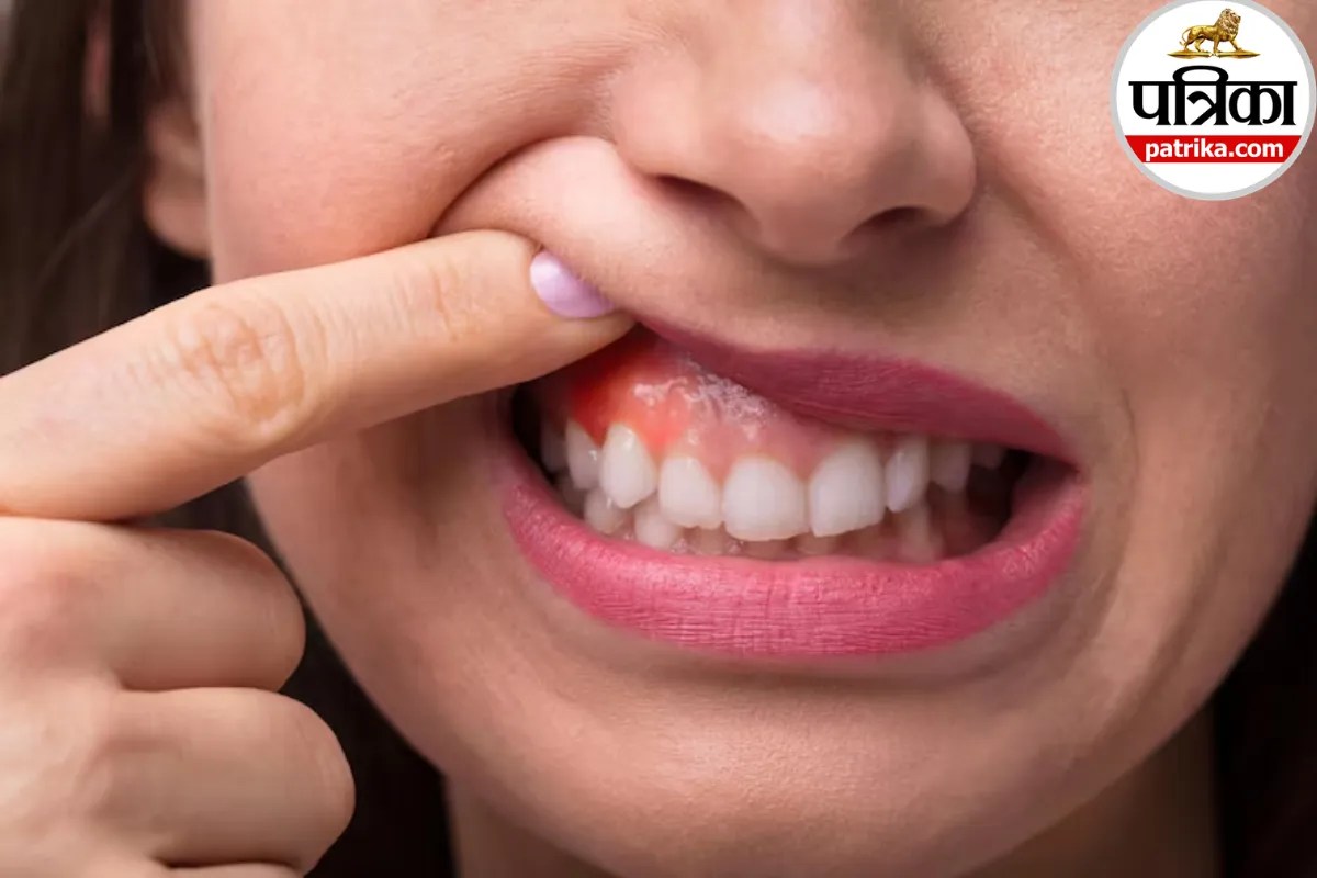 Swollen Gums Causes in Hindi,Gingivitis Symptoms and Treatment,Bleeding Gums Causes in Hindi,