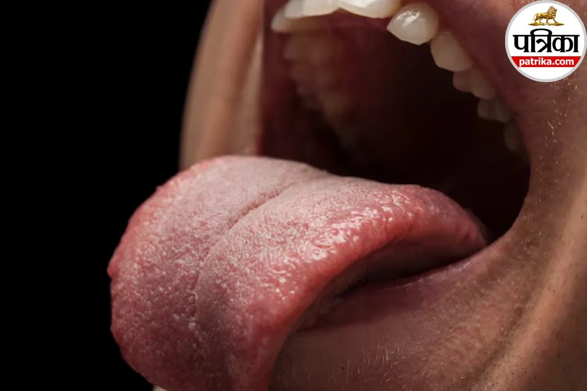 Yellow tongue causes,Yellow tongue symptoms,Yellow tongue home remedies,