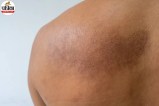 Amyloidosis Symptoms, amyloidosis