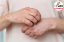 anaphylaxis symptoms and treatment,severe allergic reaction signs,sudden breathing difficulty allergy,