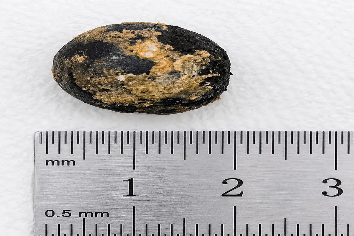 Hard 1.5 cm Ayurvedic Pill Stuck in Elderly Woman's Esophagus Removed via Endoscopy
