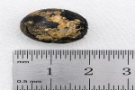 Hard 1.5 cm Ayurvedic Pill Stuck in Elderly Woman's Esophagus Removed via Endoscopy