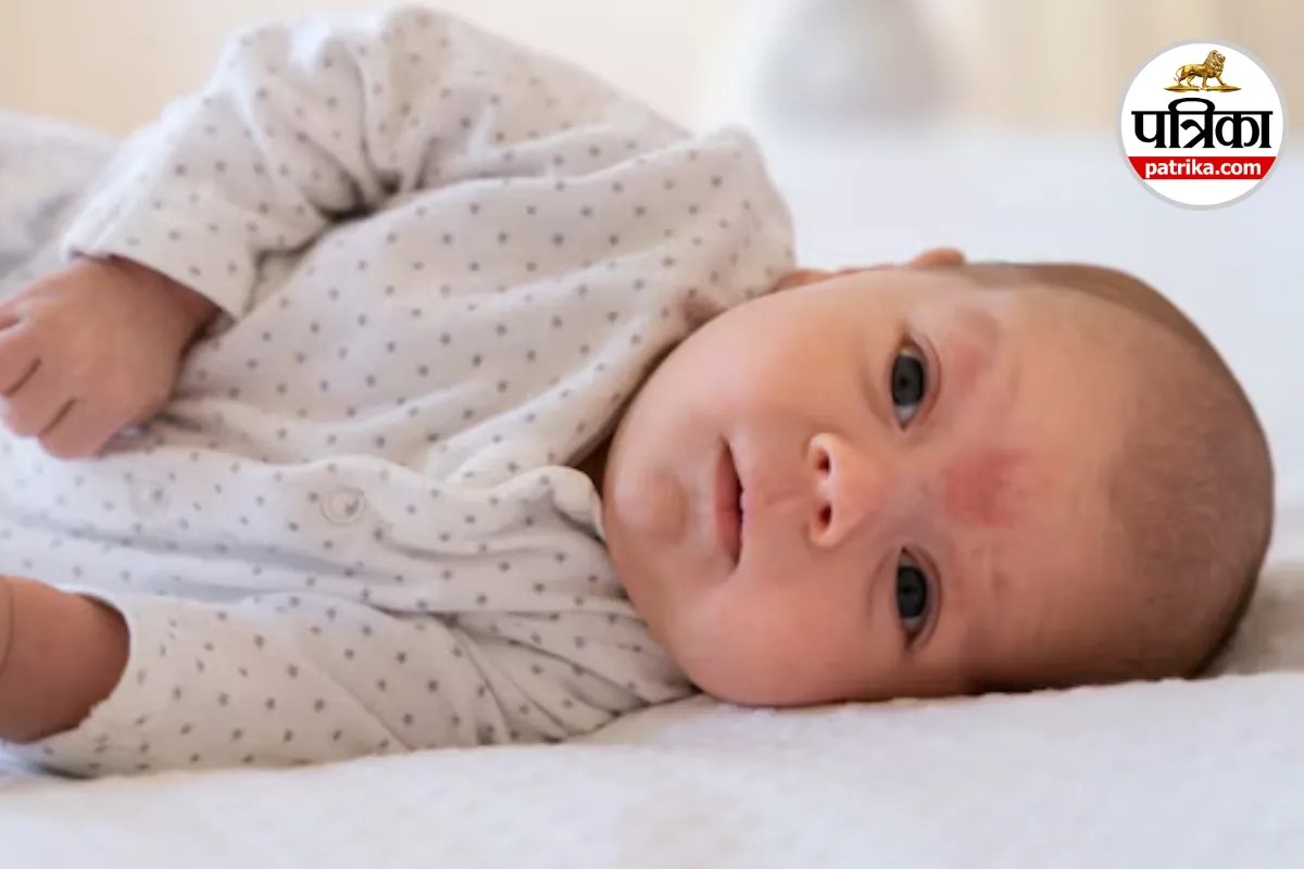 Baby eczema symptoms and signs,Infant eczema on face and scalp,Baby eczema causes and triggers,