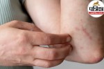 Bedbug bites symptoms,How to get rid of bedbugs,Bedbug bites treatment at home