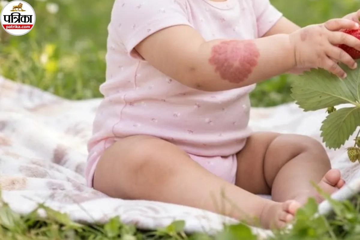 Red Birthmark In Baby, Blue Birthmark In Baby
