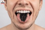 Black Hairy Tongue, Black Tongue