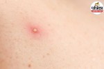 Boil treatment at home,How to heal a boil fast,Boil causes and symptoms,