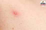 Boil treatment at home,How to heal a boil fast,Boil causes and symptoms,