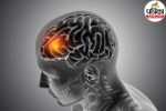 brain with aneurysm and sudden intense headache depiction