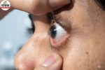 Corneal Hydrops, Corneal Hydrops Symptoms