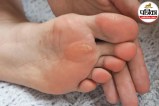 corns and calluses on feet,causes of hard skin on feet,corns and calluses symptoms,