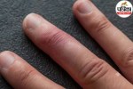 swollen finger showing dactylitis as a possible sign of serious disease