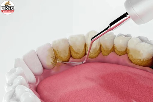 Tartar Symptoms, Tartar Removal
