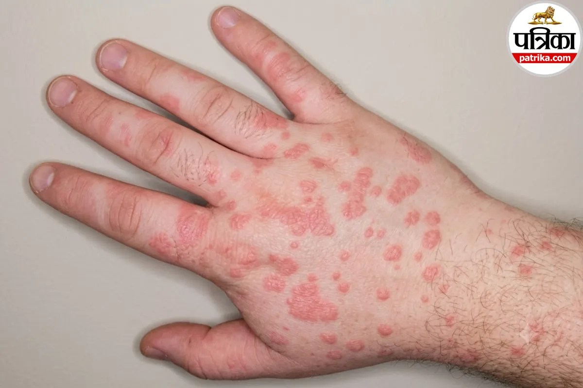 bulls-eye skin lesions of erythema multiforme on hands or arms