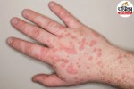 bulls-eye skin lesions of erythema multiforme on hands or arms
