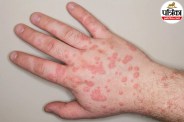 bulls-eye skin lesions of erythema multiforme on hands or arms