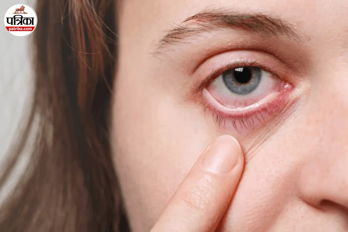 Eyelid Dermatitis Causes, Eyelid Allergy