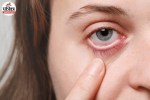 Eyelid Dermatitis Causes, Eyelid Allergy