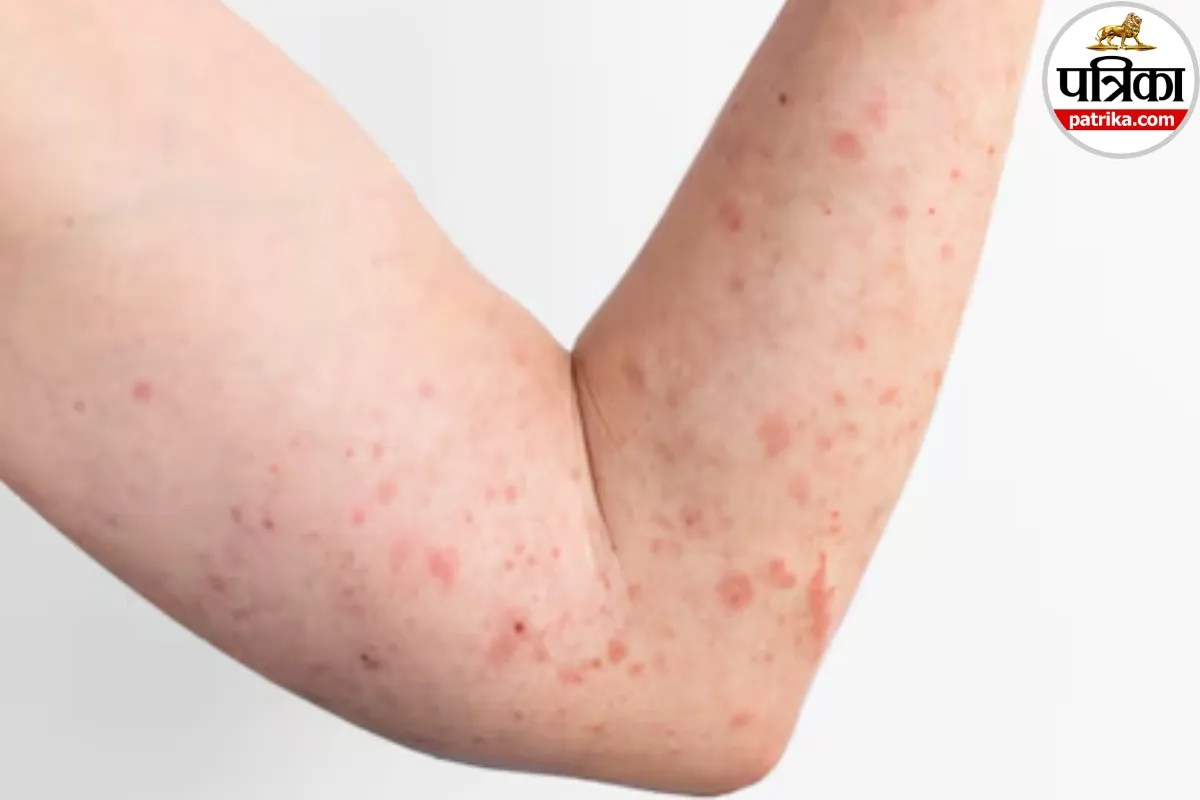 small red spots and reduced sweating as early signs of Fabry disease