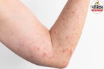 small red spots and reduced sweating as early signs of Fabry disease