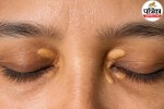 High cholesterol signs on skin, Eyes yellow spots cholesterol