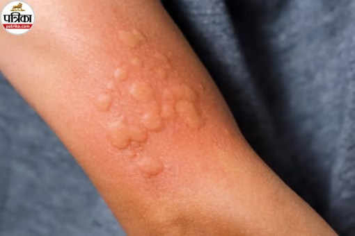 Hives Treatment, Hives Prevention