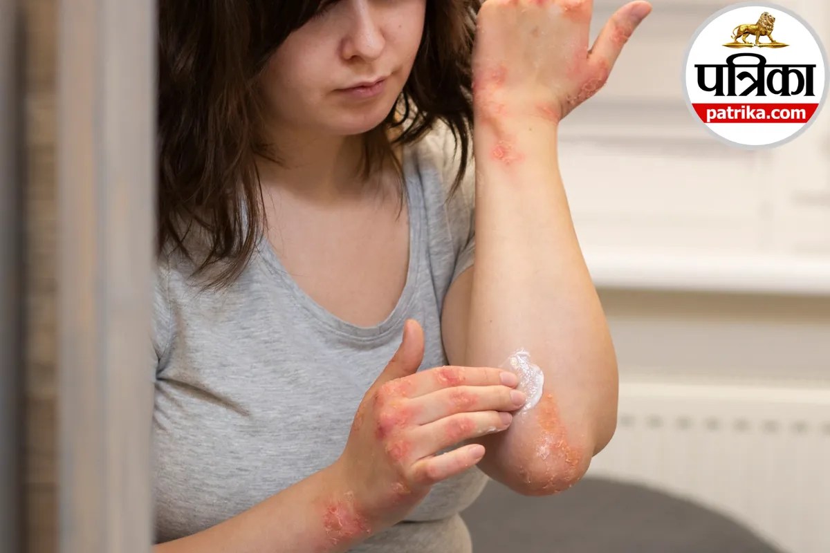 Ice burn symptoms and treatment, Causes of ice burn on skin, How to treat ice burn at home, Can ice burn your skin Hindi, Ice pack skin damage prevention,