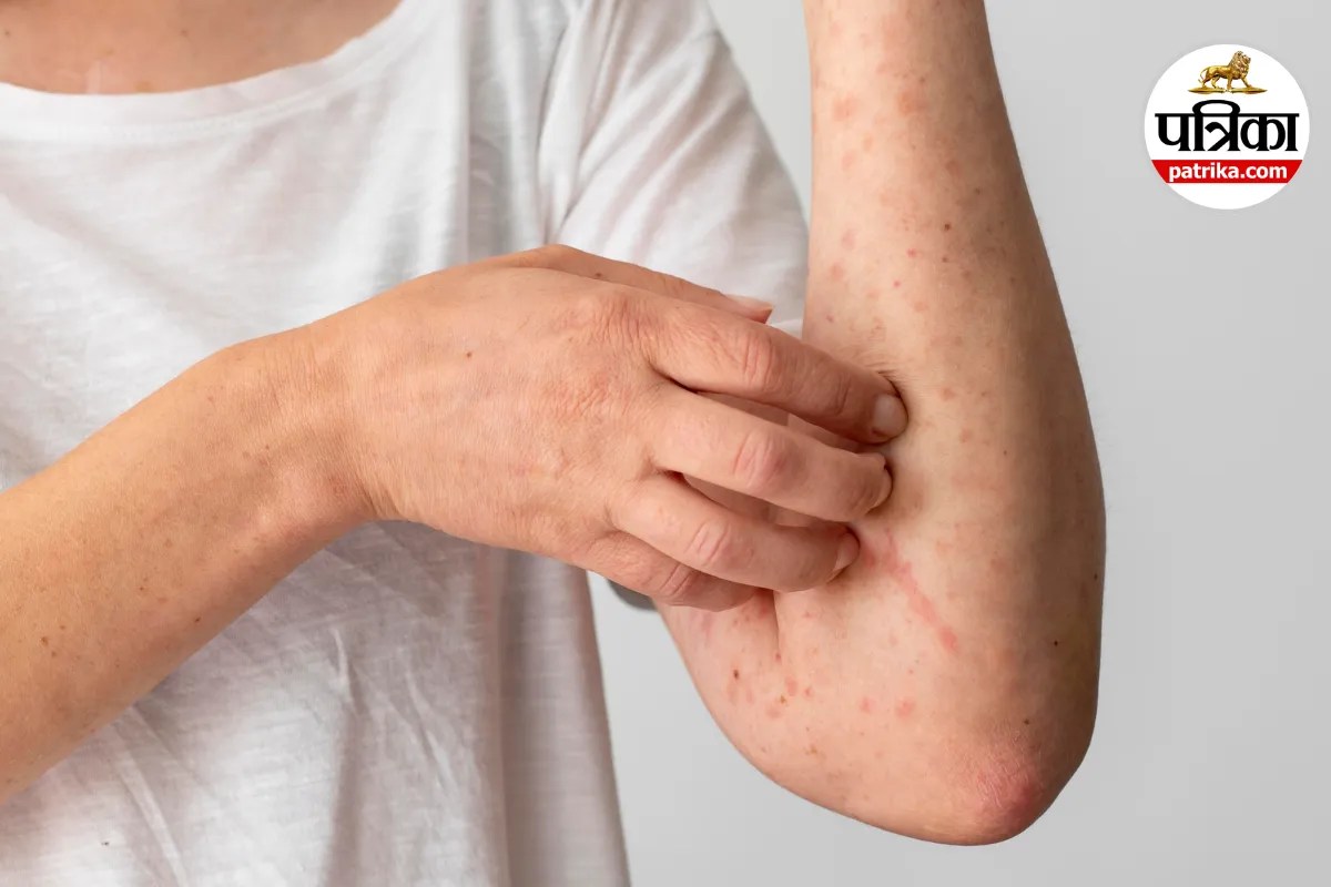 Yaws disease symptoms,Yaws bacterial infection,Yaws treatment azithromycin,