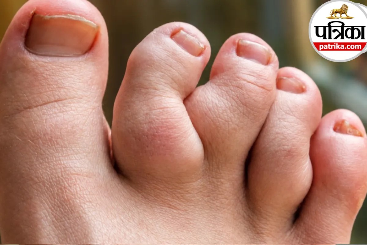 Maffucci syndrome symptoms,Maffucci syndrome causes,Maffucci syndrome enchondroma,