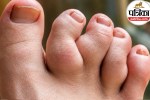Maffucci syndrome symptoms,Maffucci syndrome causes,Maffucci syndrome enchondroma,