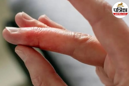 mallet finger causes and symptoms,bent fingertip injury treatment,mallet finger splint treatment,