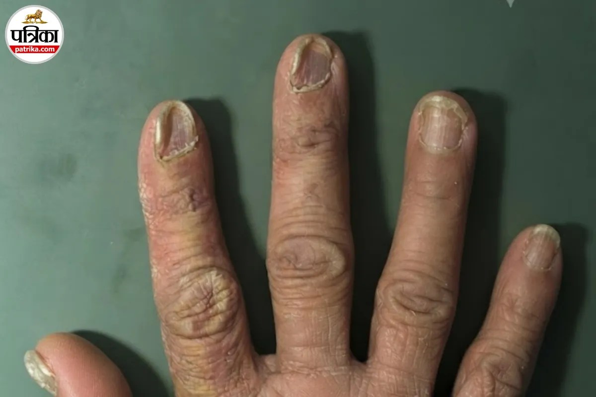 human nails showing color changes ridges and other warning signs of possible health issues