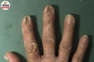 human nails showing color changes ridges and other warning signs of possible health issues