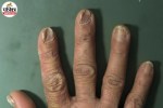 human nails showing color changes ridges and other warning signs of possible health issues