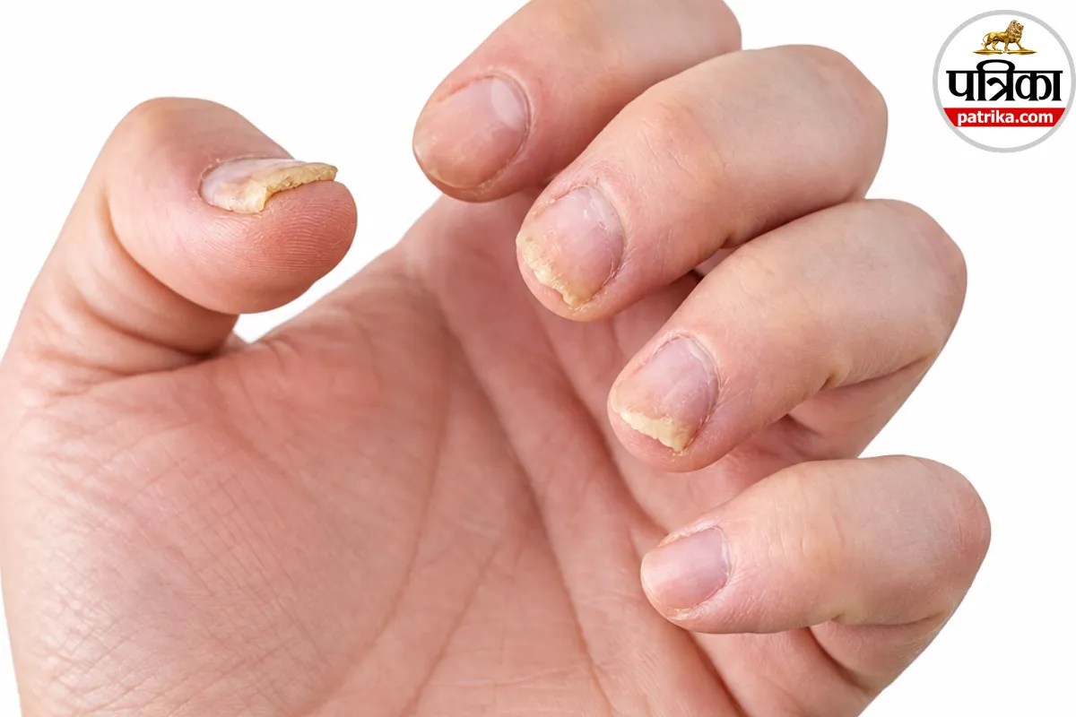 Nail psoriasis symptoms,Psoriasis on nails causes,Nail psoriasis treatment,