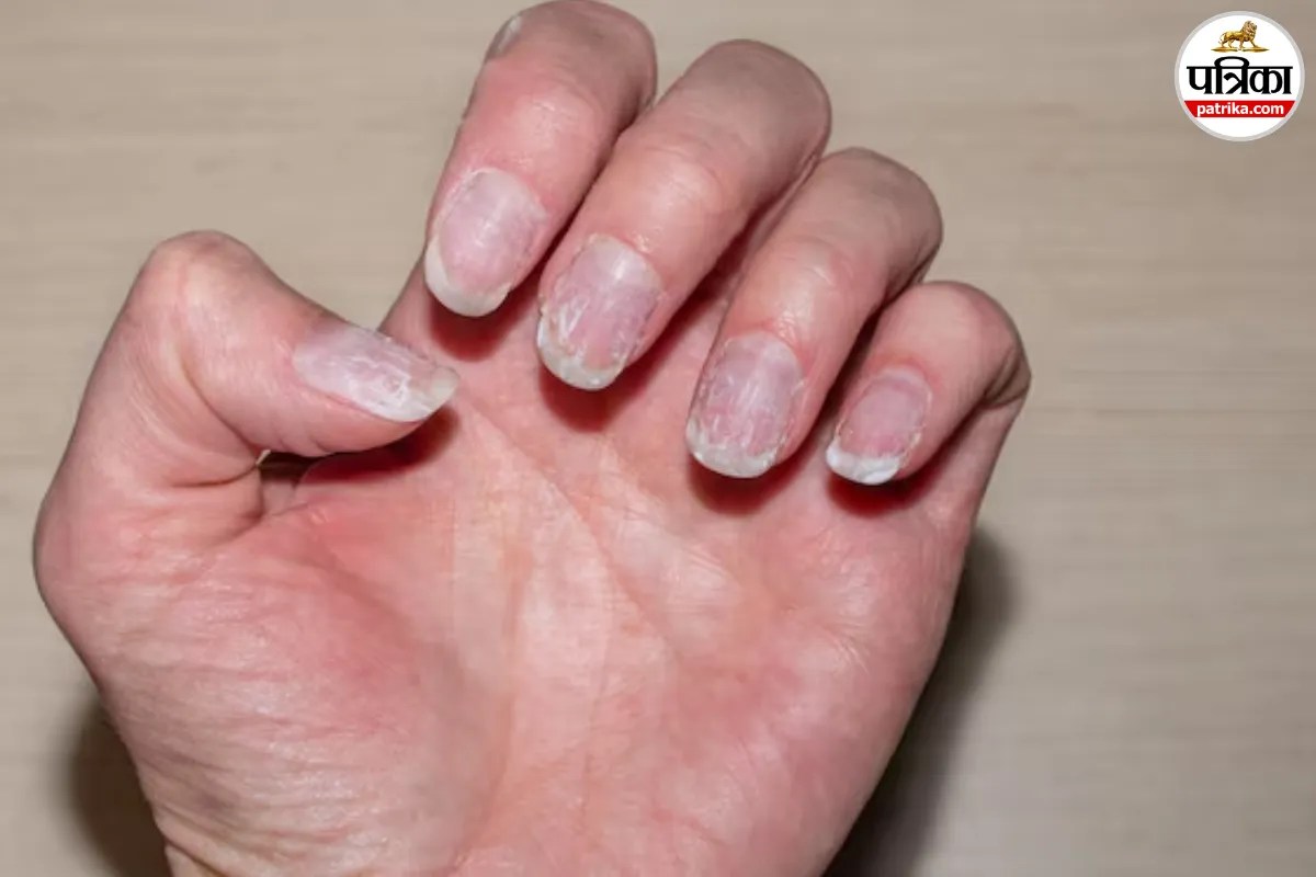 Nail Problems, Nail Changes