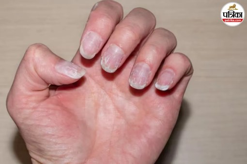 Nail Problems, Nail Changes