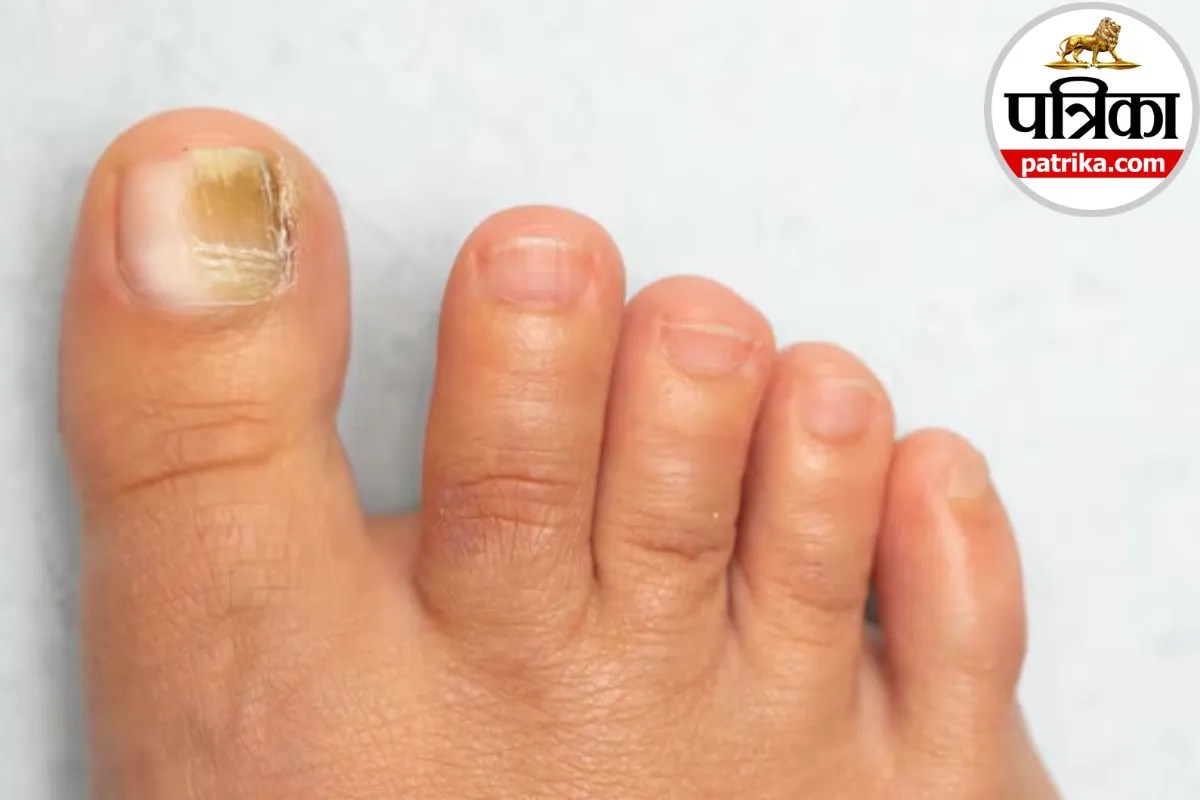 Causes of pale skin and nails ,Pallor symptoms and reasons,Why lips and nails turn white,