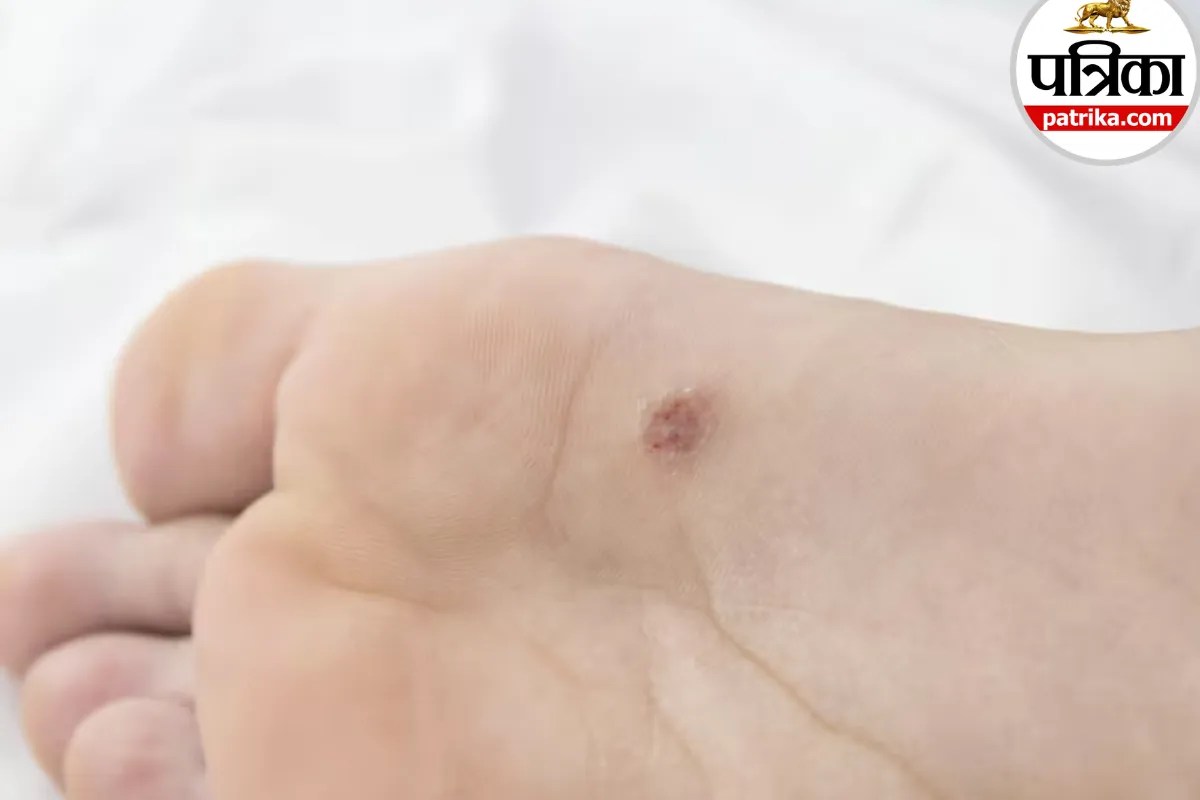 plantar warts symptoms,foot wart pain,causes of plantar warts,
