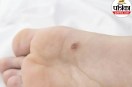 plantar warts symptoms,foot wart pain,causes of plantar warts,